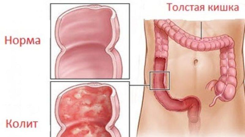 лечение колита кишечника медикаментами