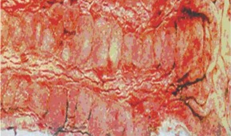 чем лечить колит кишечника лекарства