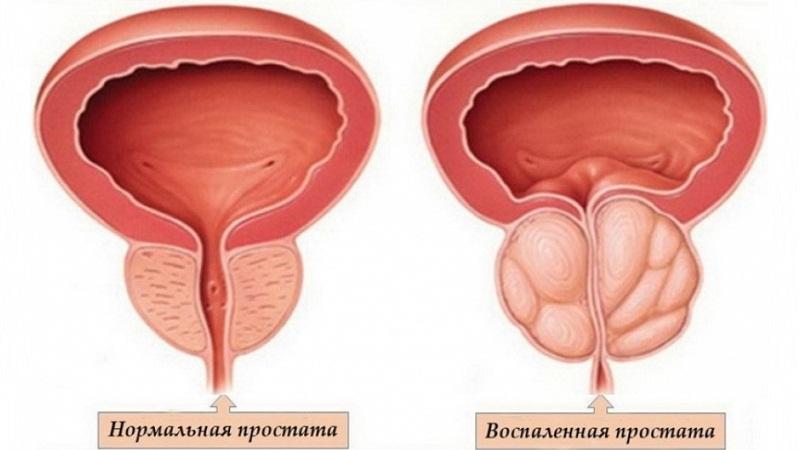 лекарство от простатита быстродействующее недорогие