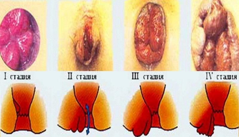 лучшие свечи от наружного геморроя недорогие и эффективные
