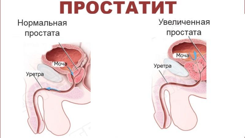 массаж простатита у мужчин в домашних условиях