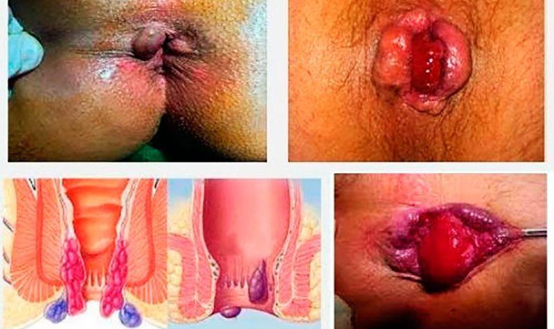 Проктоседил мазь при геморрое: инструкция и отзывы