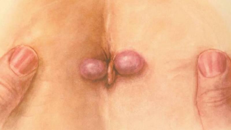 медикаментозное лечение геморроя у женщин и мужчин