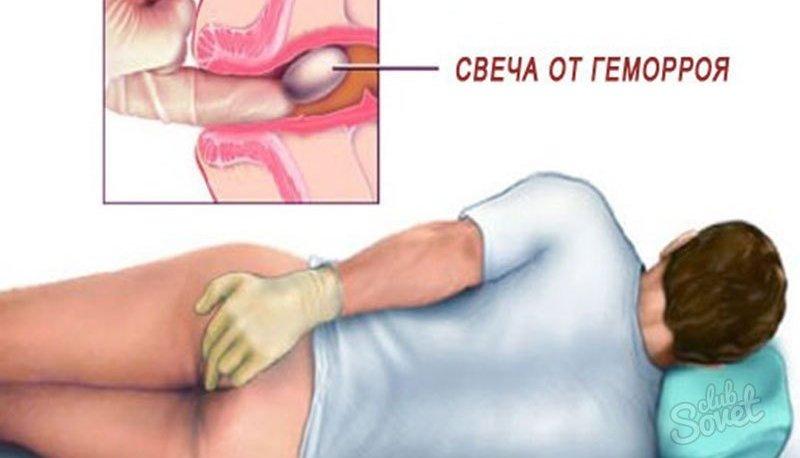 лечение геморроя медикаментозными средствами самые эффективные