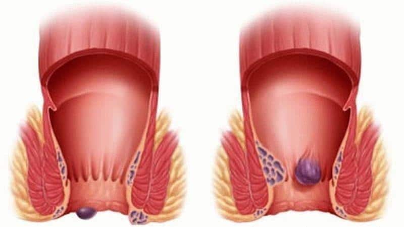 медикаментозное лечение геморроя препараты