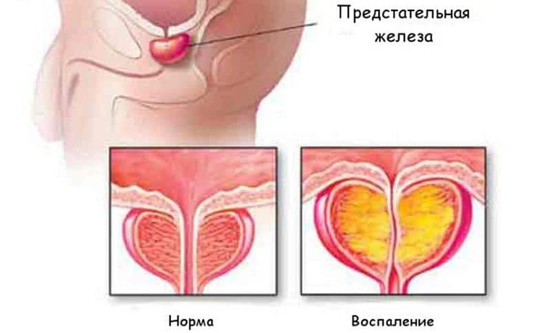 Свечи с метилурацилом при простатите: инструкция и отзывы