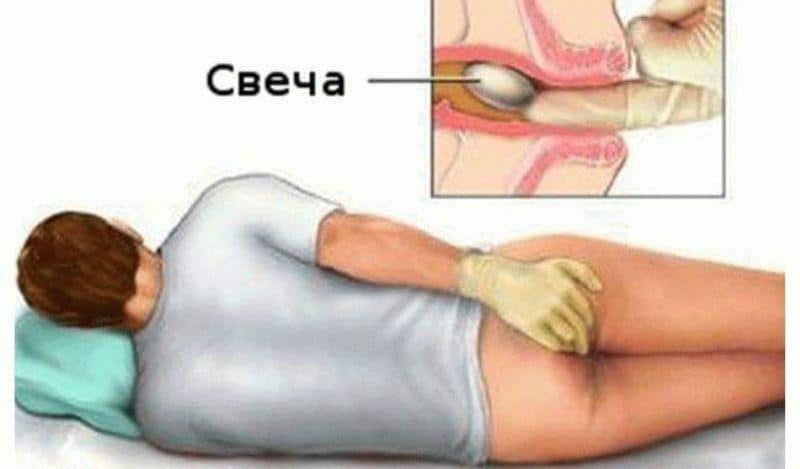 Свечи с метилурацилом при простатите: инструкция и отзывы