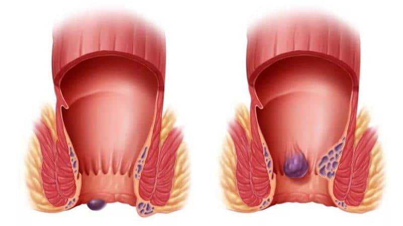 методы лечения геморроя