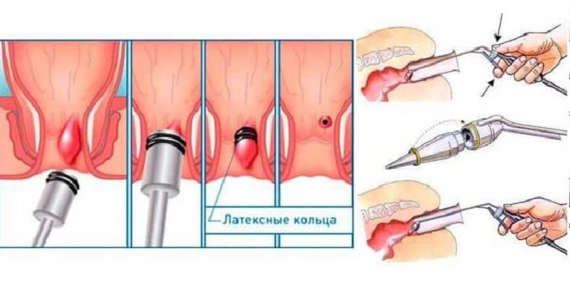 методы лечения геморроя современные