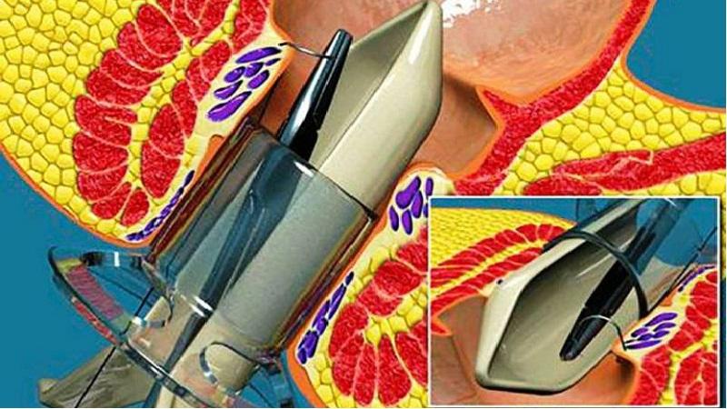 лечение геморроя новыми методами