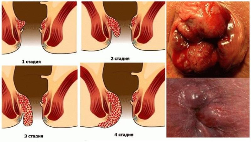 геморрой можно ли полностью вылечить