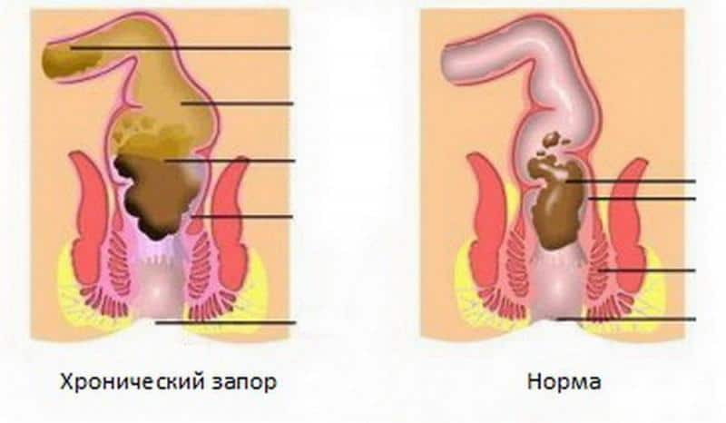 можно ли тужиться во время беременности при запорах