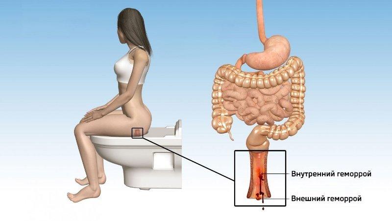 Можно ли заниматься йогой при геморрое