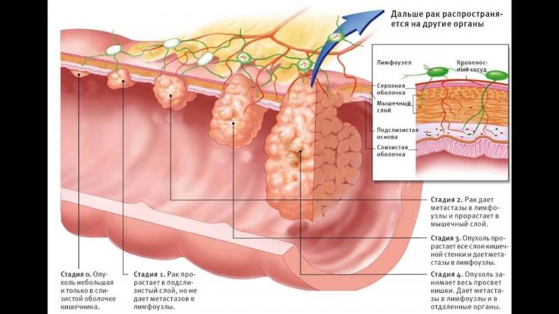 на анусе опухоль