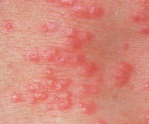 на анусе прыщи