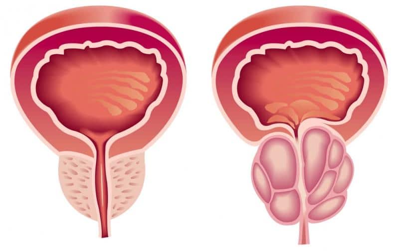 Лечение небактериального простатита