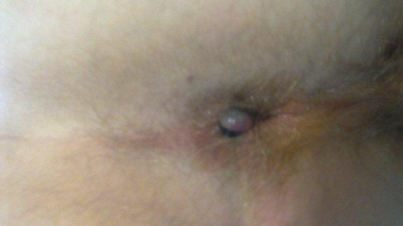 недорогие и эффективные таблетки от геморроя