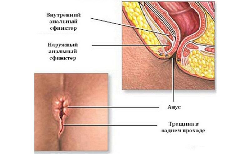 Что такое недостаточность анального сфинктера и как его укрепить
