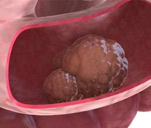 Симптомы и лечение непроходимости прямой кишки