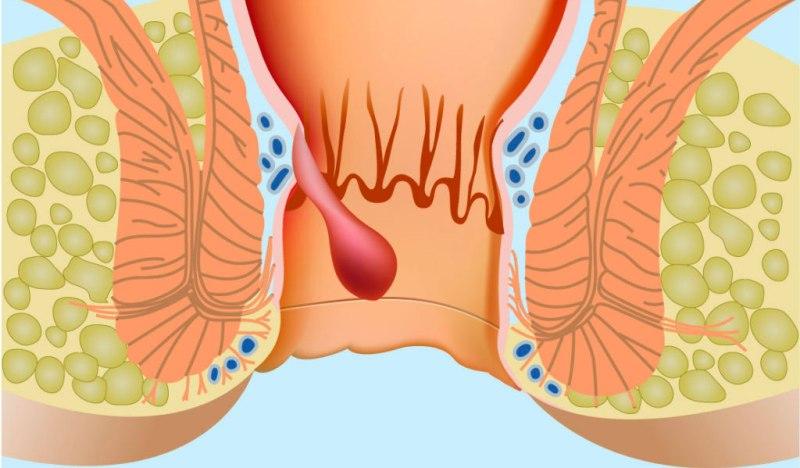 Препарат Нифедипин: инструкция по применению при геморрое и отзывы