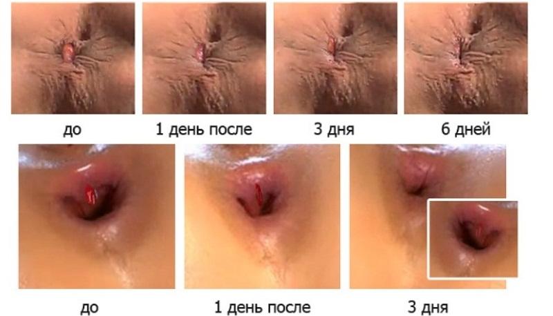 Препарат Нифедипин: инструкция по применению при геморрое и отзывы