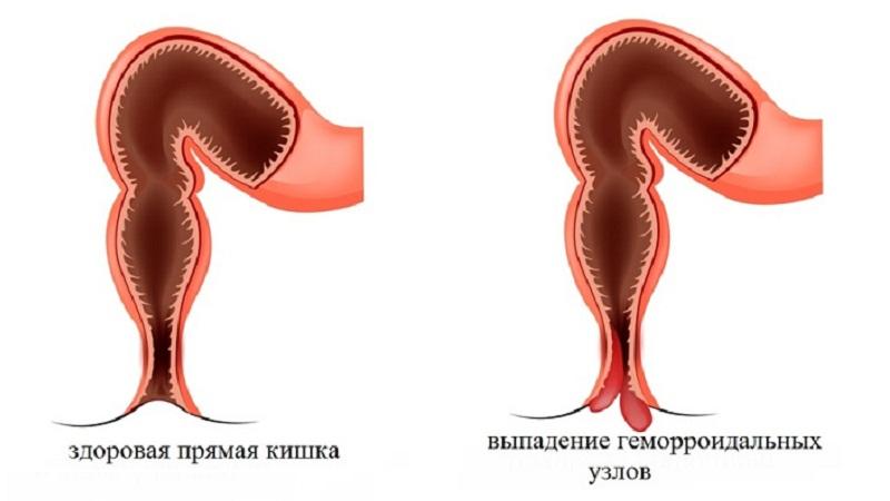 нигепан свечи инструкция по применению при геморрое