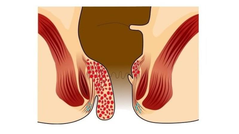 обезболивающие средства при геморрое