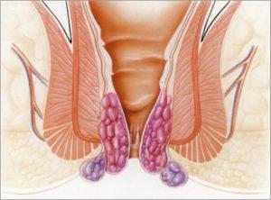 Препарат Олестезин: инструкция по применению при геморрое и отзывы