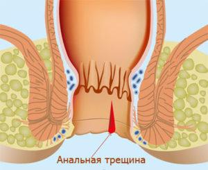 операция по удалению анальной трещины