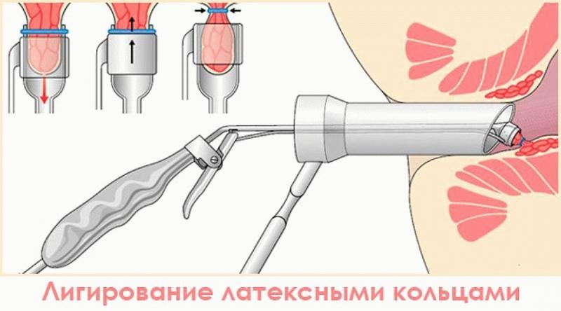 оперативное лечение геморрой