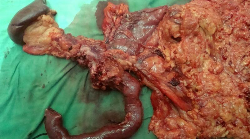 опухоль прямой кишки операция и последствия