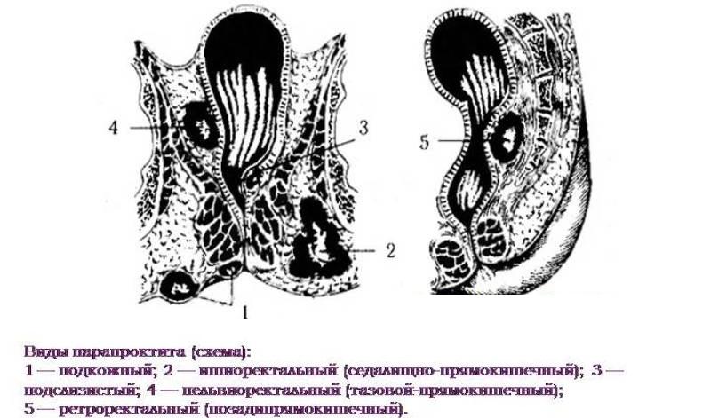 гнойный парапроктит лечение