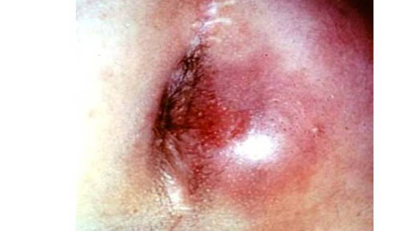 острый подкожный гнойный парапроктит