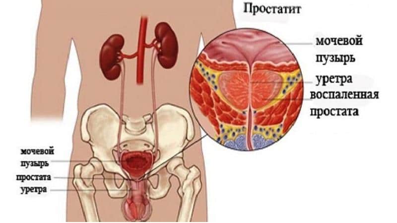 лечение острого простатита у мужчин препараты