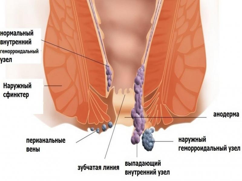 от чего может появиться геморрой