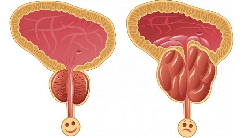 от простатита чай