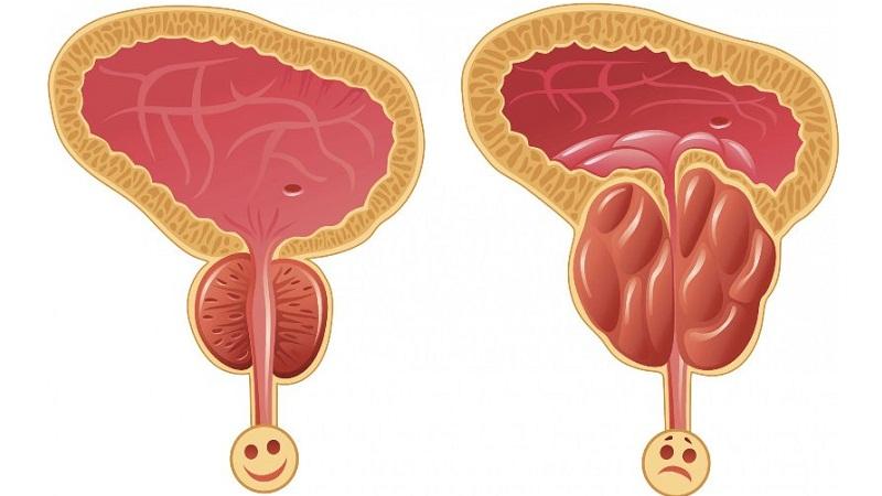 Препарат Афала: инструкция по применению при простатите и отзывы