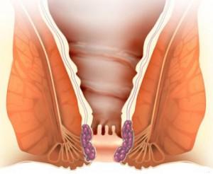 отзывы после операции по удалению свища прямой кишки