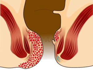 восстановление после операции на свищ