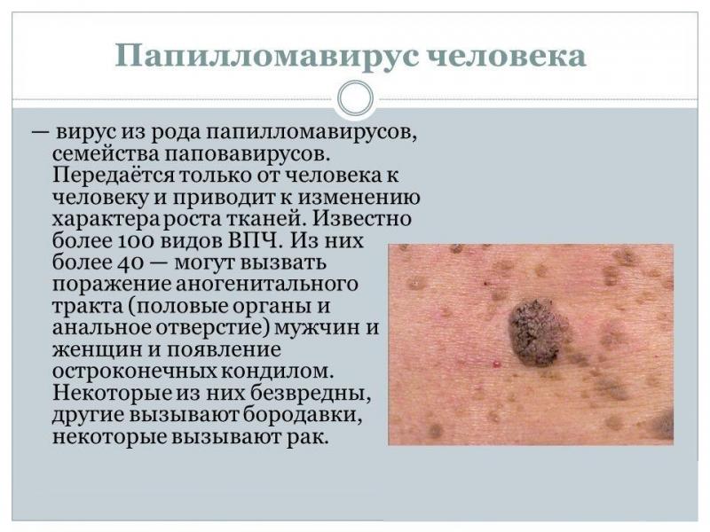 Что такое папиллома и как она лечится