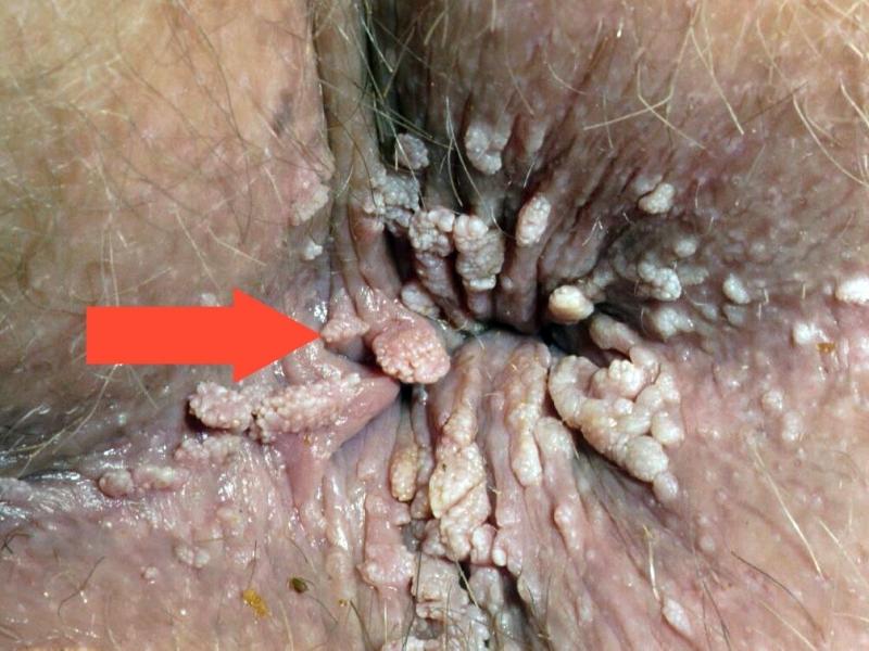 Что такое папиллома и как она лечится