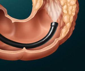 фото папиллома ануса