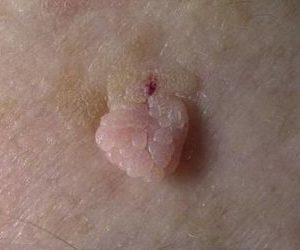 наросты в заднем проходе у женщин фото