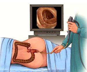 папилломы в заднем проходе фото