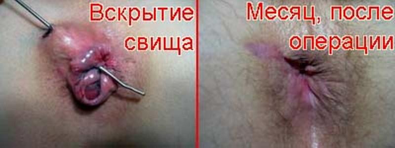 Лечение парапроктита оперативным методом: описание и последствия
