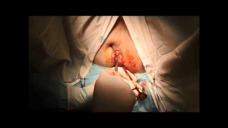 Лечение парапроктита оперативным методом: описание и последствия