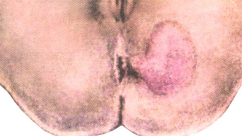 парапроктит симптомы и лечение