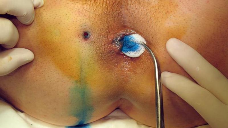 острый парапроктит фото симптомов и лечение