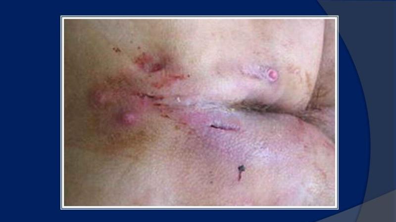 парапроктит фото ягодиц до операции и после