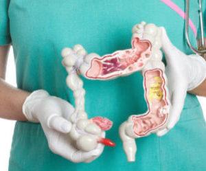 Что такое перфорация стенок кишечника